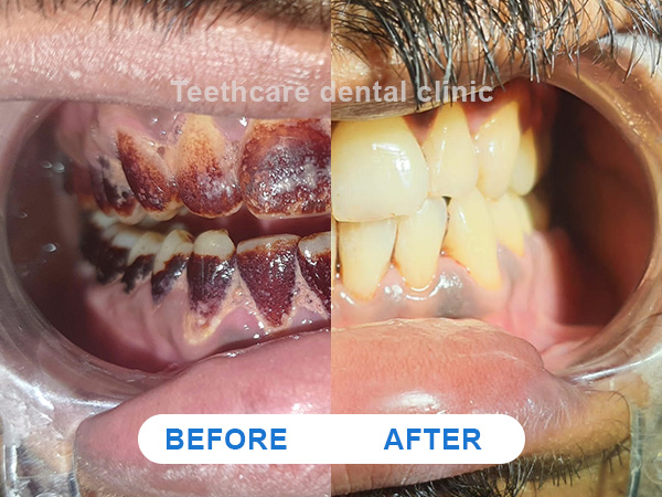 #1 Teeth Whitening In Kolkata | Best Dental Whitening Clinic - TCMDC