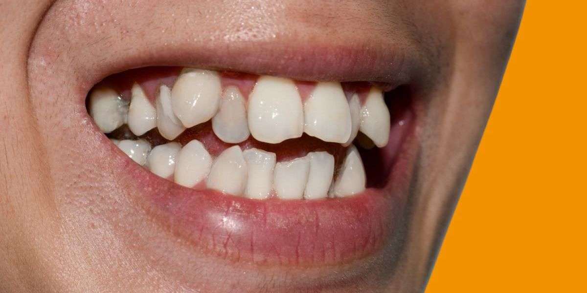 Can Crooked Teeth Treatment Prevent Future Dental Problems