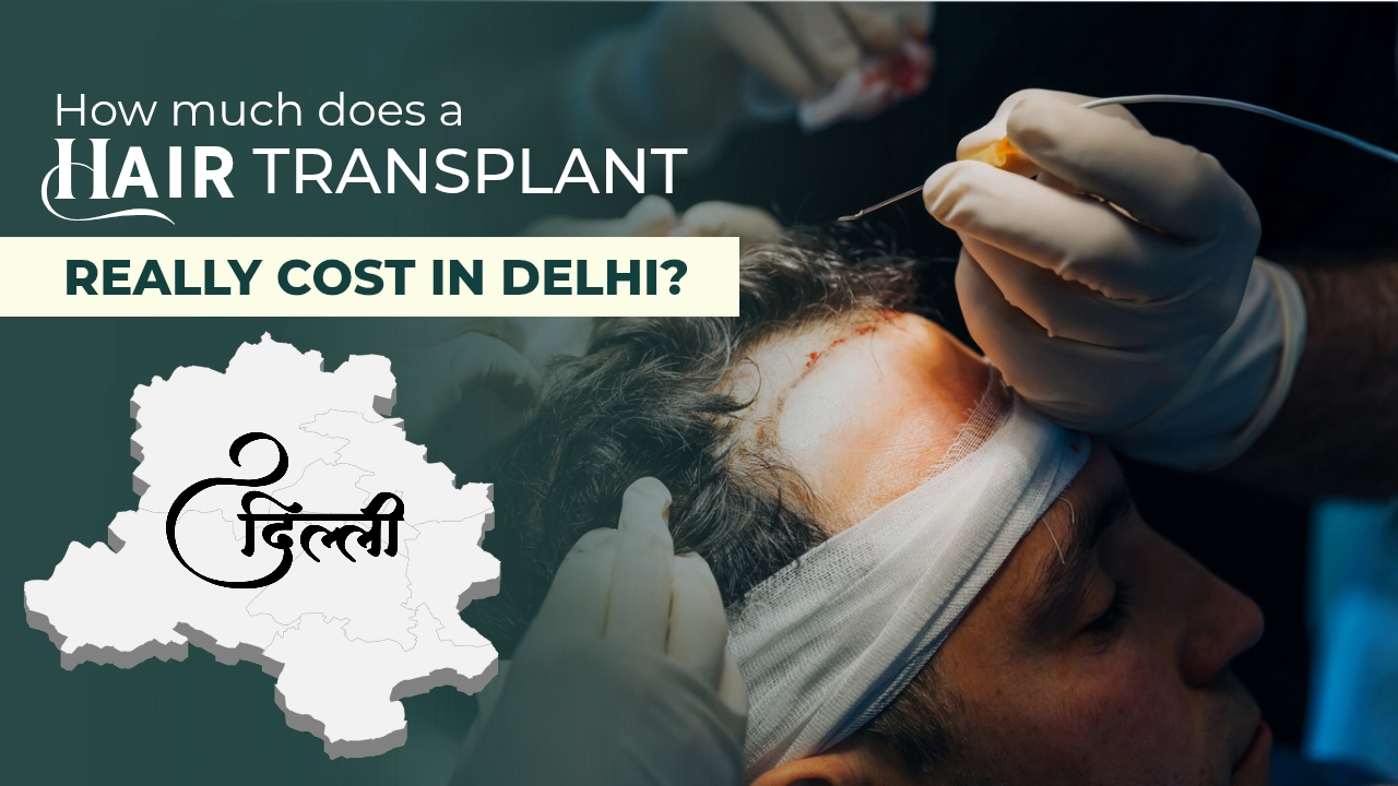 How Much Does a Hair Transplant Cost in Delhi? Full Breakdown