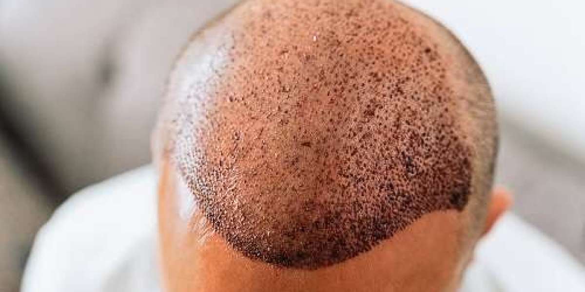 Hair Transplantation in Riyadh Restore Your Best Look