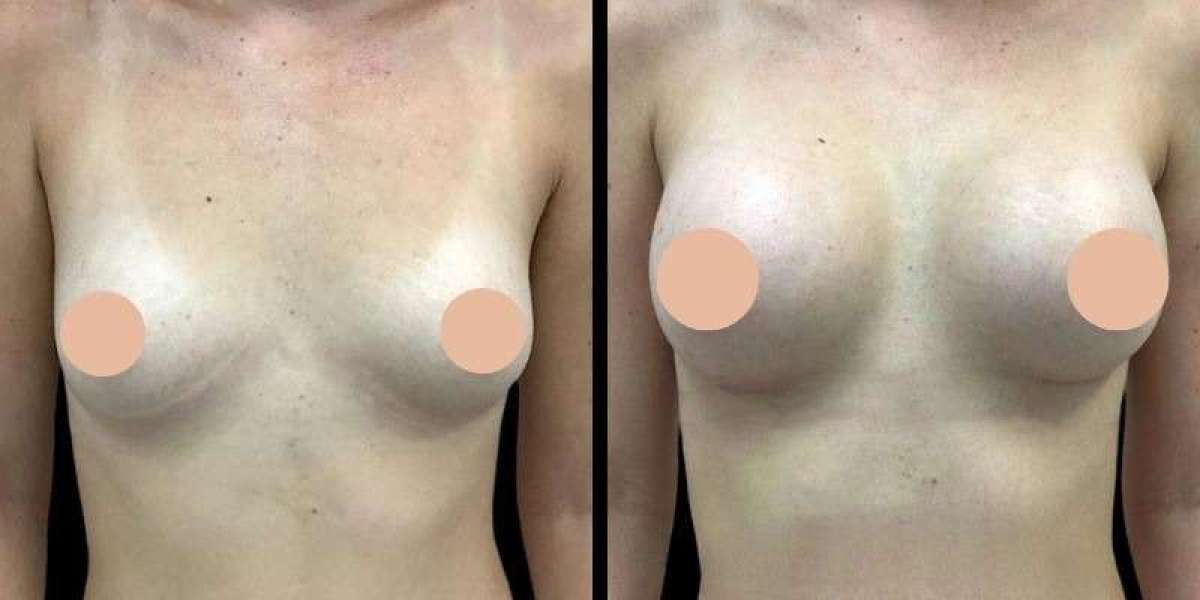 Breast Augmentation in Dubai: Traveling to Dubai for Cosmetic Surgery