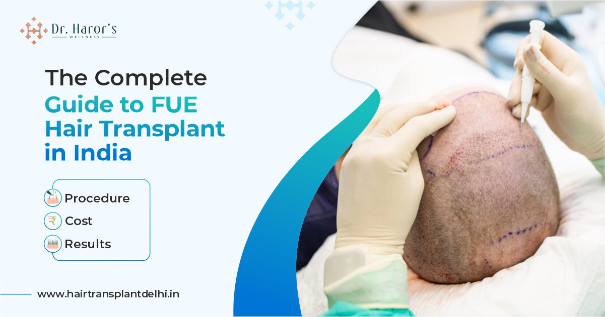 The Complete Guide to FUE Hair Transplant in India: Cost, Process, Results – Best Hair Transplant Clinic in Delhi, India