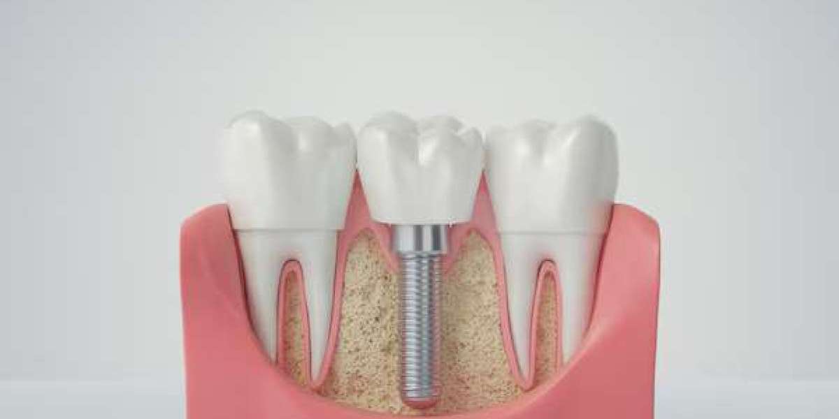 Mini Dental Implants: The Smart Choice for Tooth Replacement Revolutionizing Dental Care