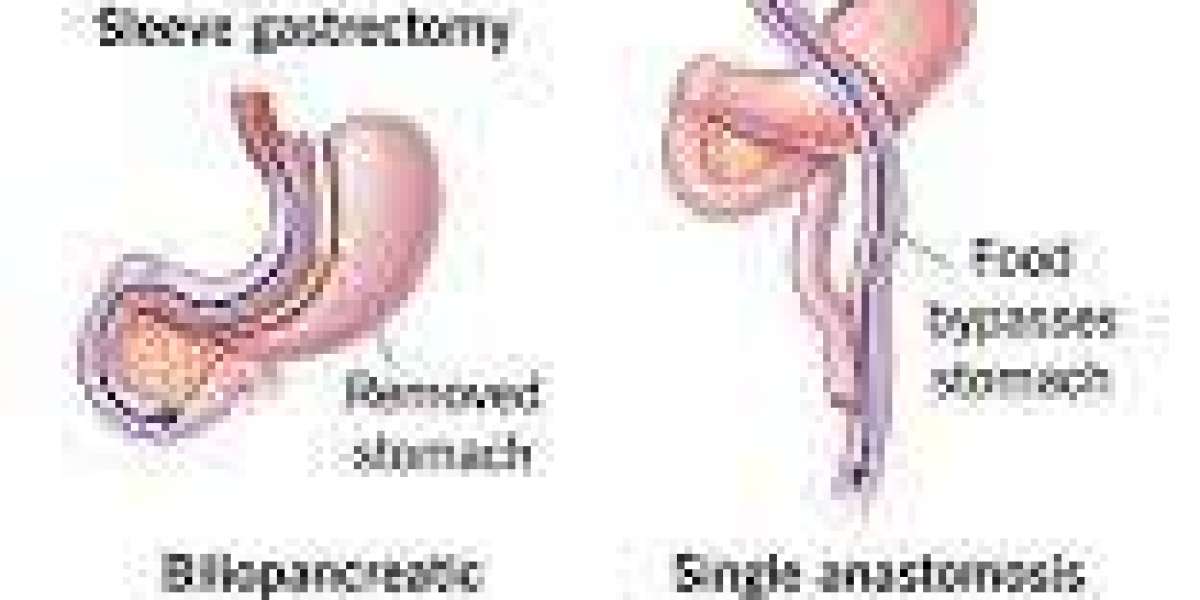 Bariatric Surgery 2026: The Definitive Guide to Safe and Effective Weight Loss