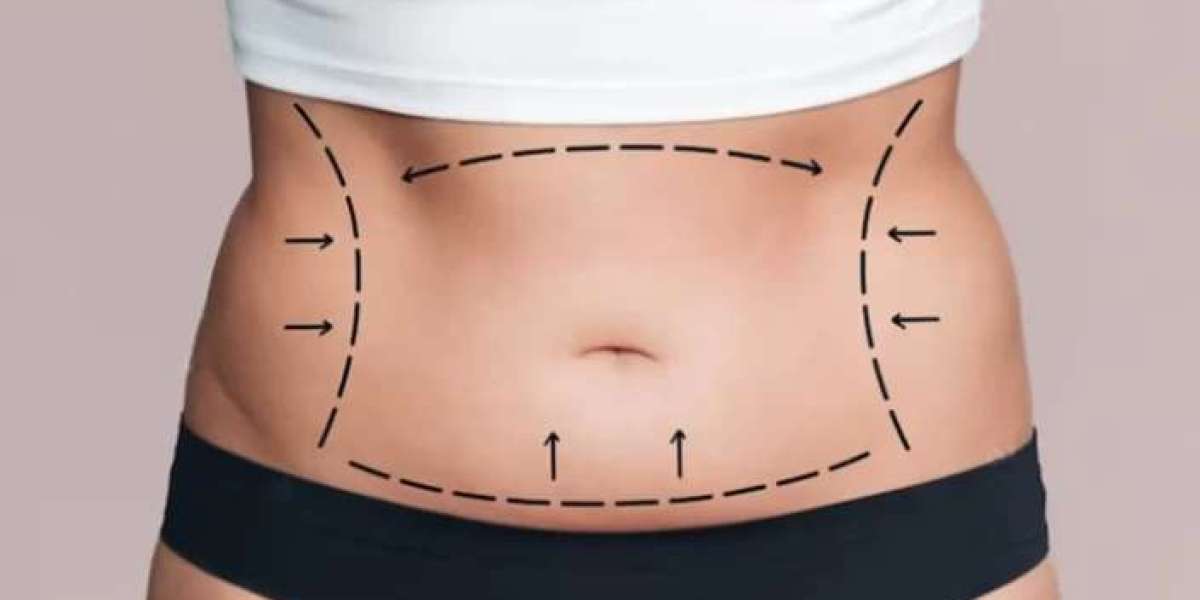 Revolutionary Techniques in Tummy Tuck Procedures