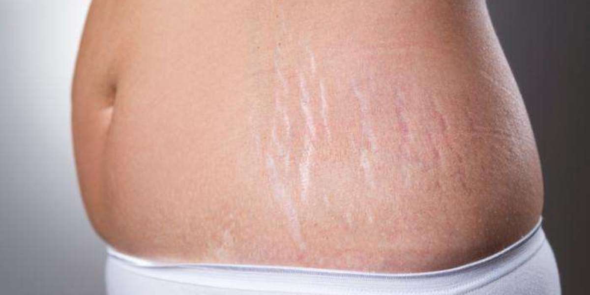Stretch Mark Removal in Islamabad: Myths vs Facts