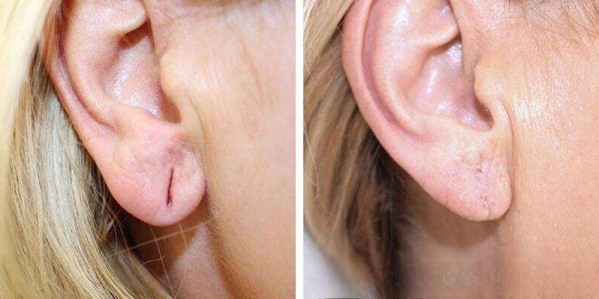 Affordable Earlobe Correction in Islamabad