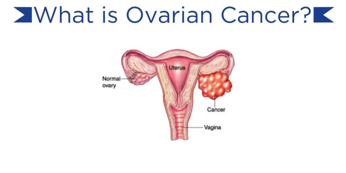 Top 20 Companies in Global Ovarian Cancer Market 2025: Market Statistics Report