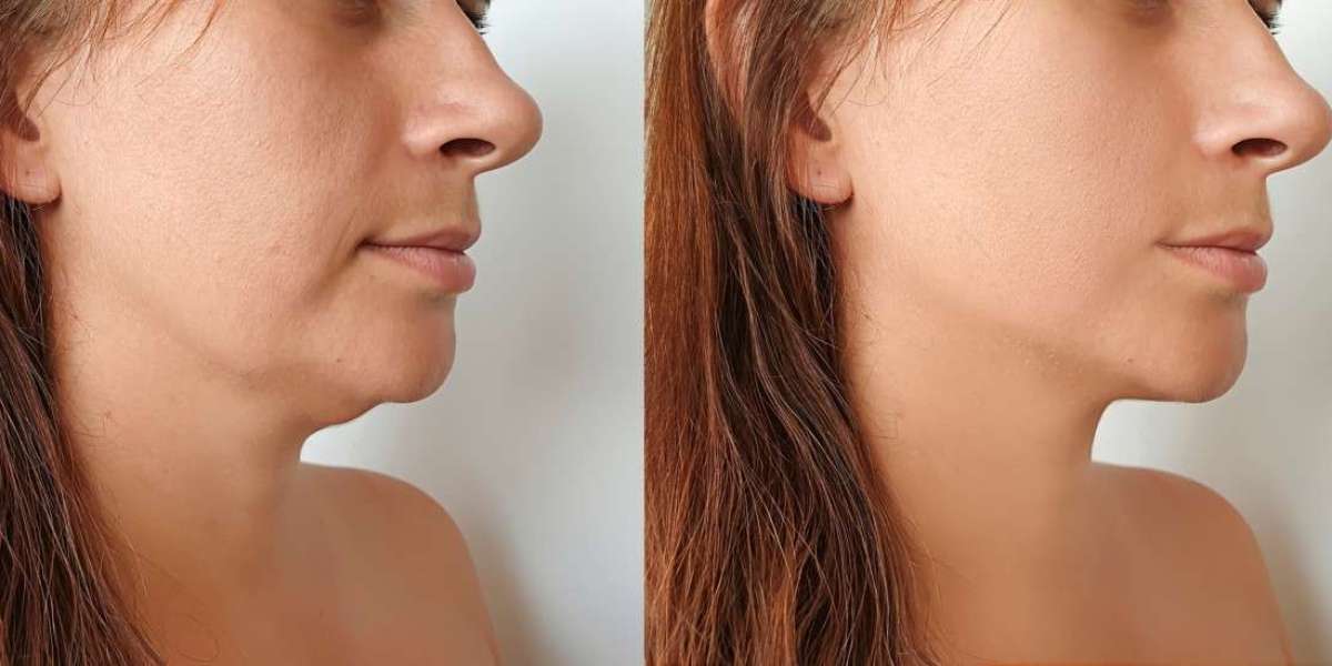 Chin Lipo Cost in Dubai for 2026