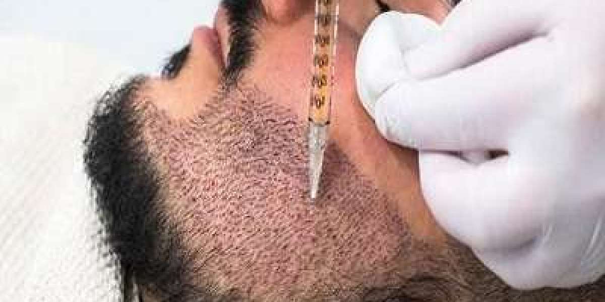 Beard Implant Treatment Riyadh