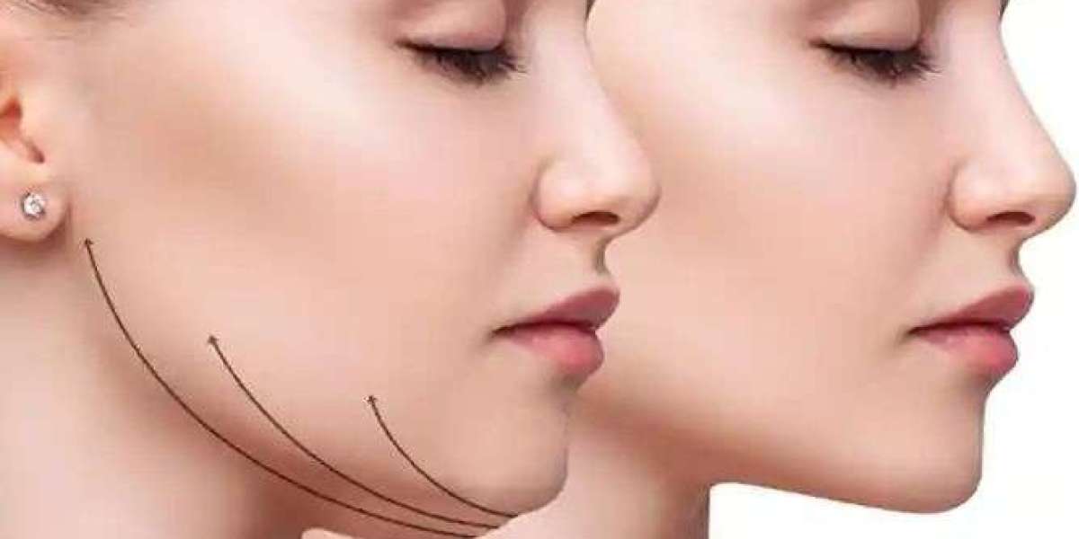 Double Chin Liposuction in Islamabad for Fat Reduction