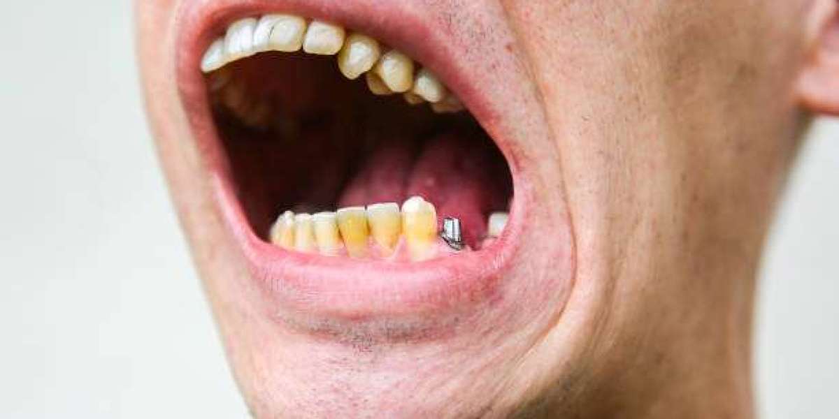 Rebuild Your Gums for a Healthy Smile