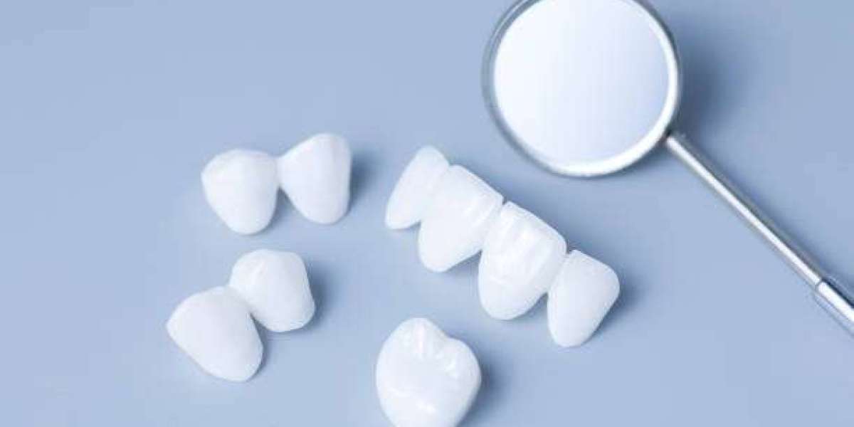 Achieve a Perfect Smile with Dental Veneers in Islamabad