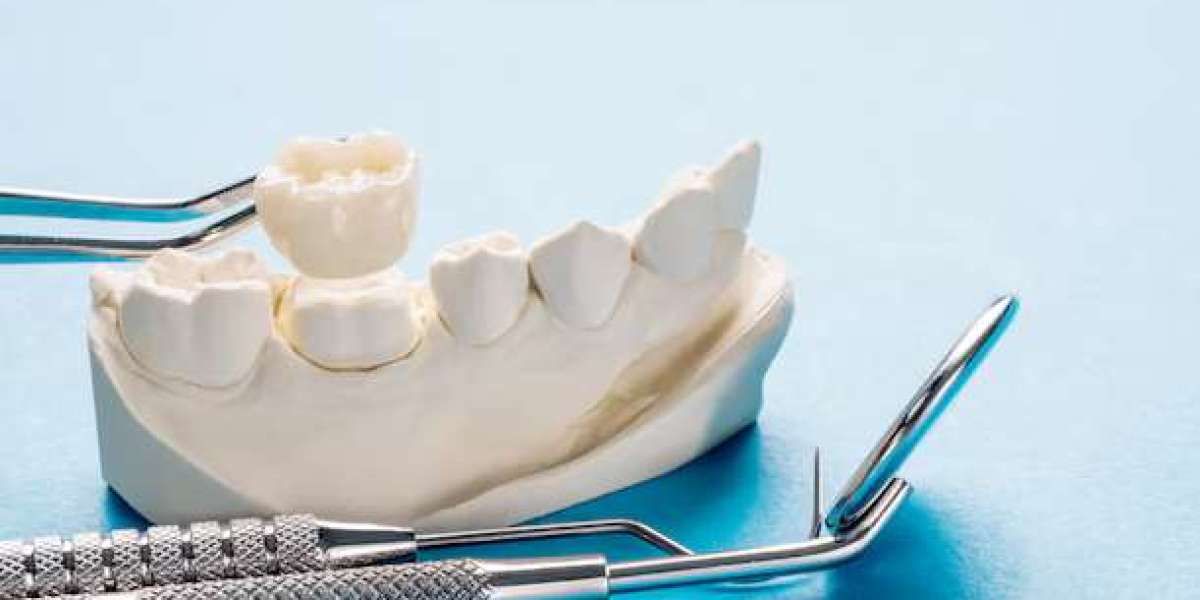 The Solution for Missing Teeth and Steps to Getting a Dental Bridges