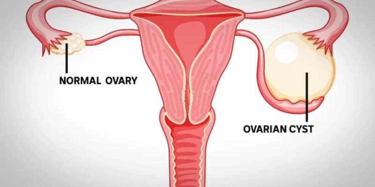 Comprehensive Ovarian Cyst Treatments in Gurgaon by Dr. Deepti Asthana