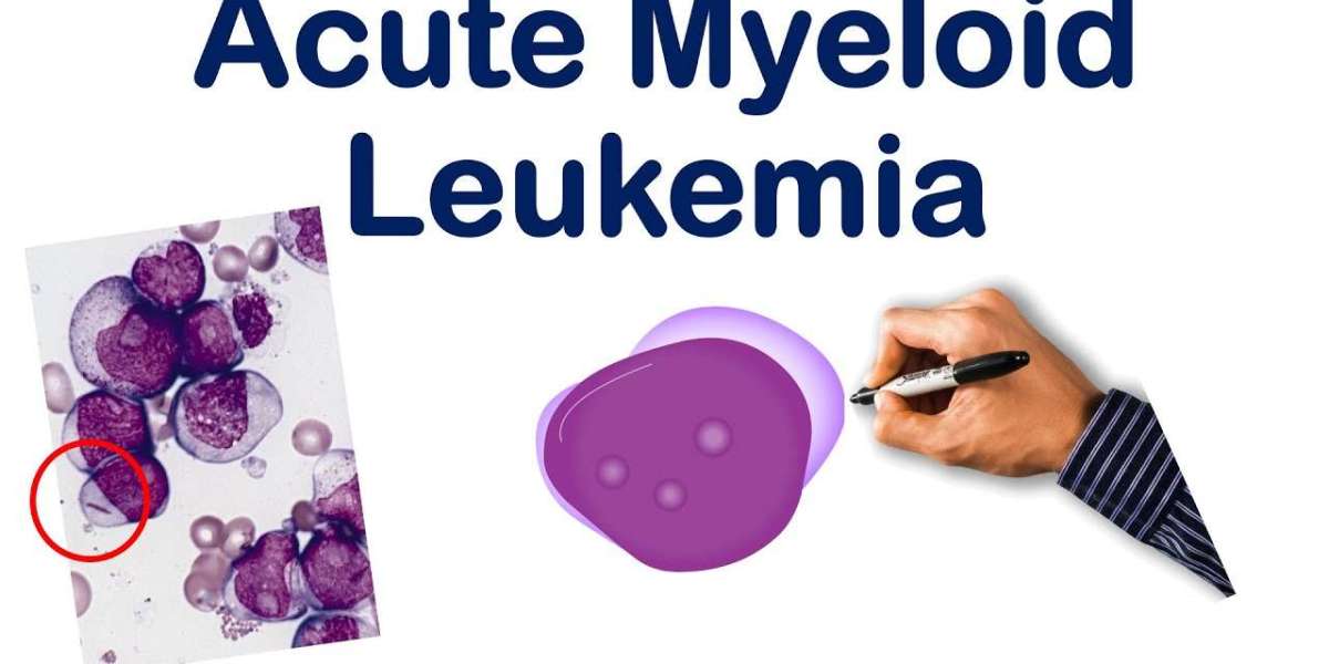 Top 20 Companies in Global Acute Myeloid Leukaemia (AML) Market 2025: Market Statistics Report