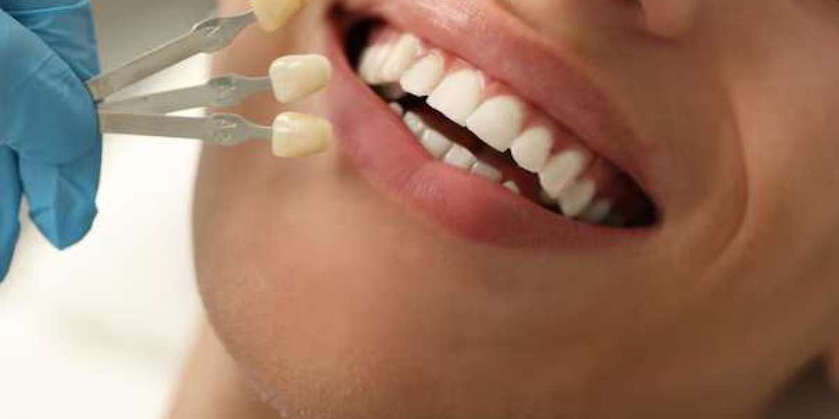 Dental Veneers Transform Your Smile with Natural Looking Cosmetic Results