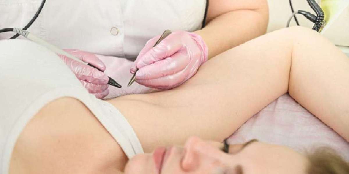 Laser Hair Removal Dubai: Price per Session