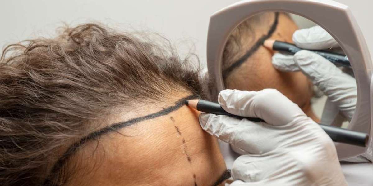 Hair Transplant for Women Rebuilding Confidence with Fuller Locks