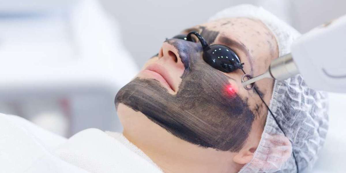Glow Instantly with Laser Carbon Peel