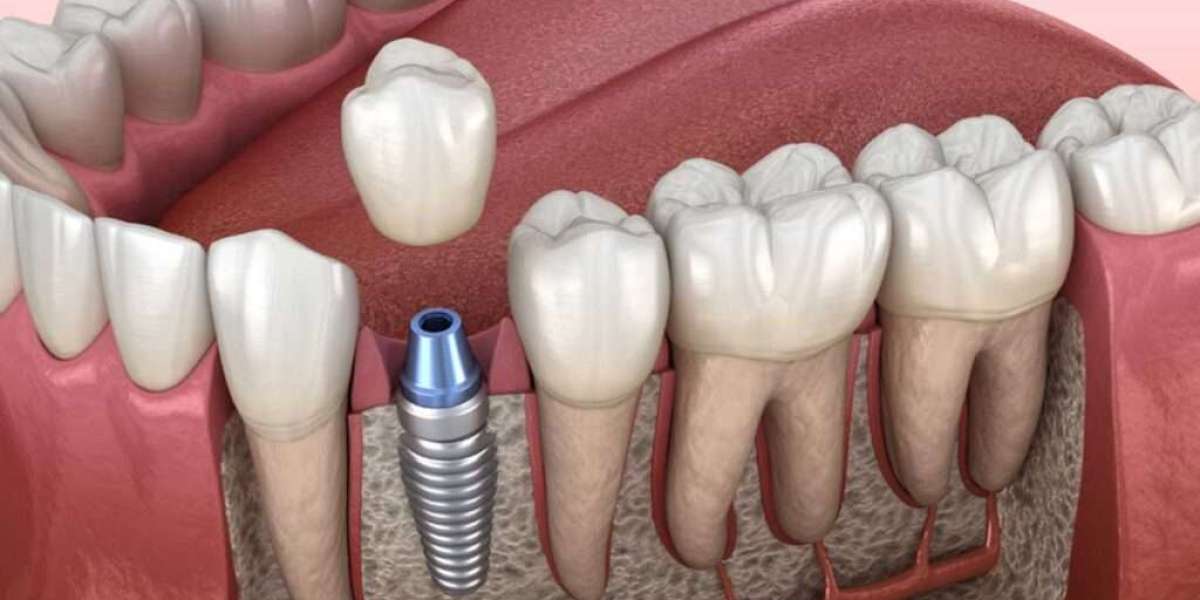Dental Implants in Dubai: Step-by-Step Guide