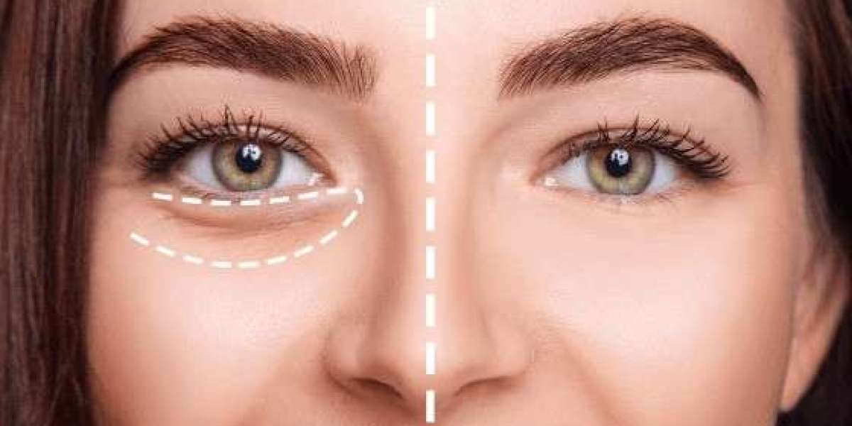 Eye Bag Removal in Islamabad for Dark Circles and Puffiness