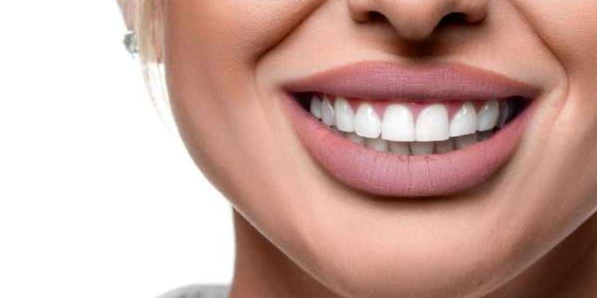 Hollywood Smile Makeover in Dubai: Complete Guide to a Radiant Smile