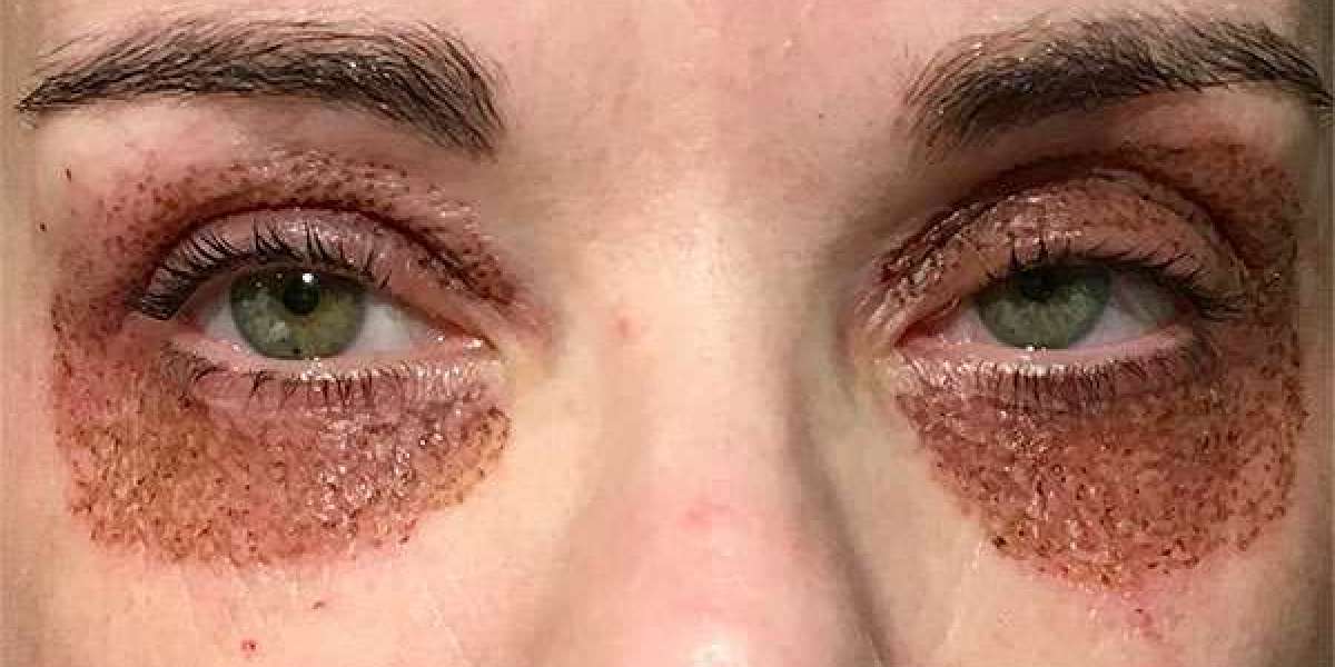 Can Plexr Plasma Eye Lift Improve Skin Texture?