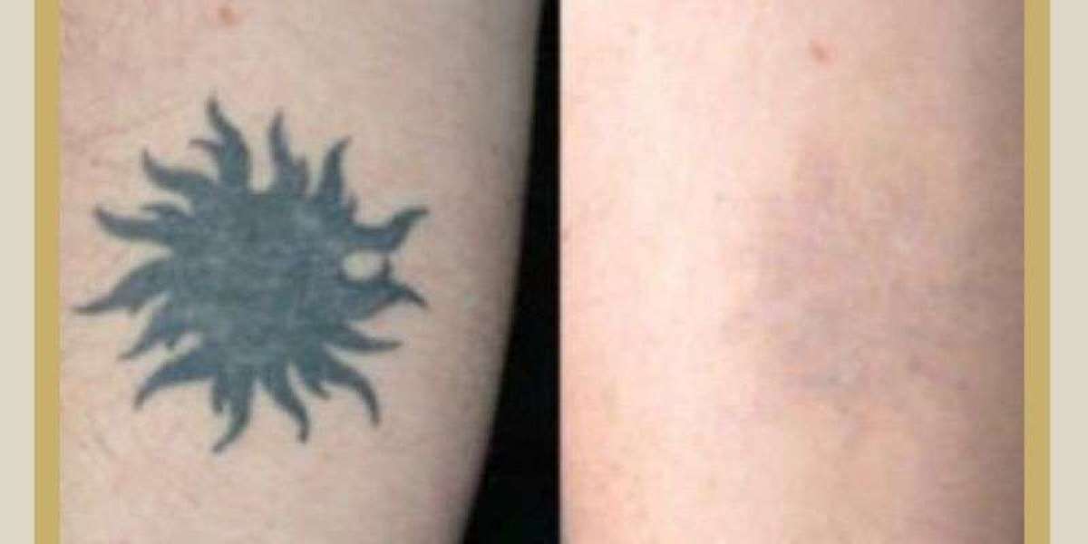 Laser Tattoo Removal in Islamabad for All Skin Types