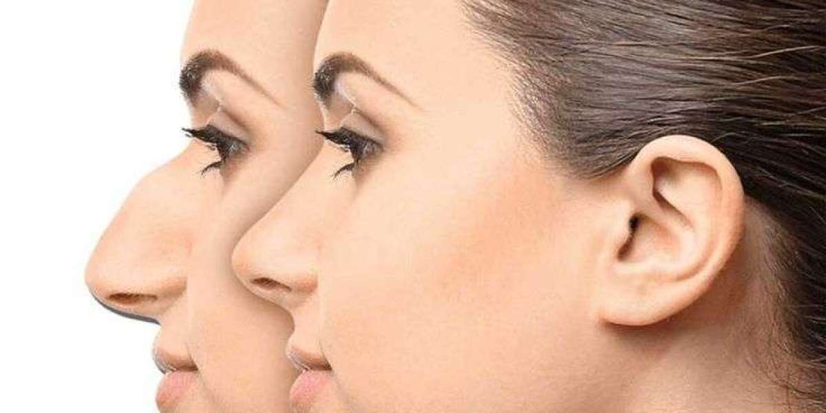 Rhinoplasty in Islamabad: Pain and Recovery
