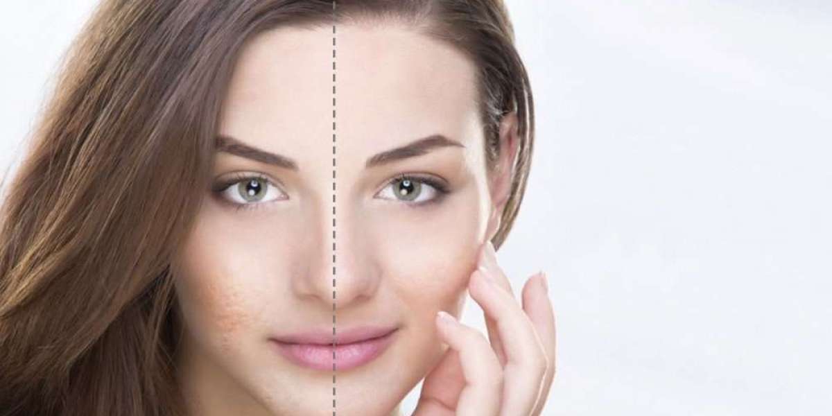 What is the Difference Between Skin Whitening and Skin Brightening?