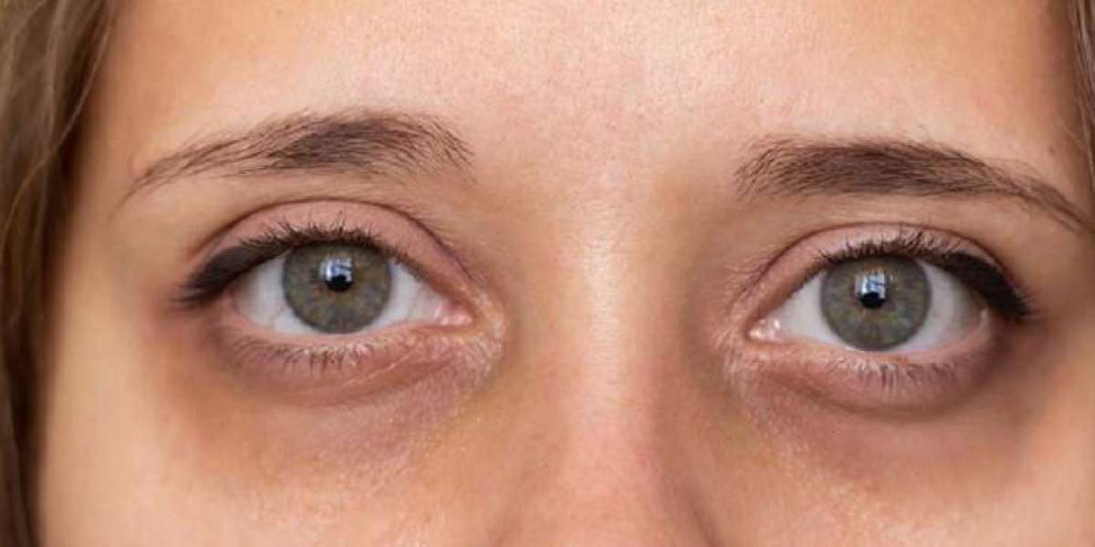Are Dark Circles Related to Eye Strain?