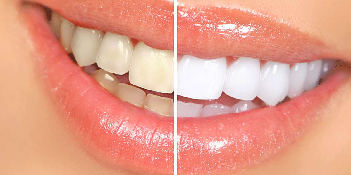 How Does Teeth Whitening Work?