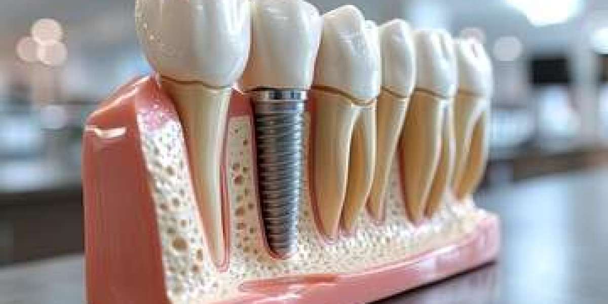 Dental Implants Brisbane: The Modern Path to a Stronger, Healthier Smile