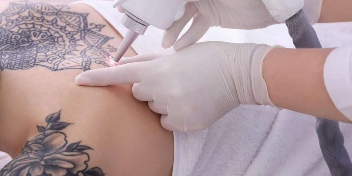 Can Laser Tattoo Removal Be Done in Salons?