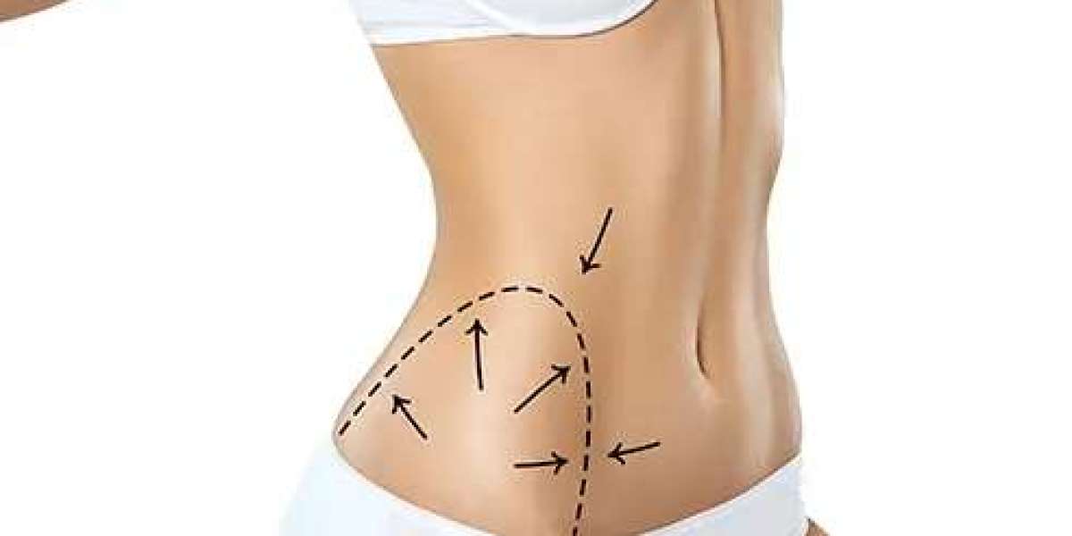 Is Vaser 4D Liposuction Permanent? Understanding Long-Term Body Contouring Results