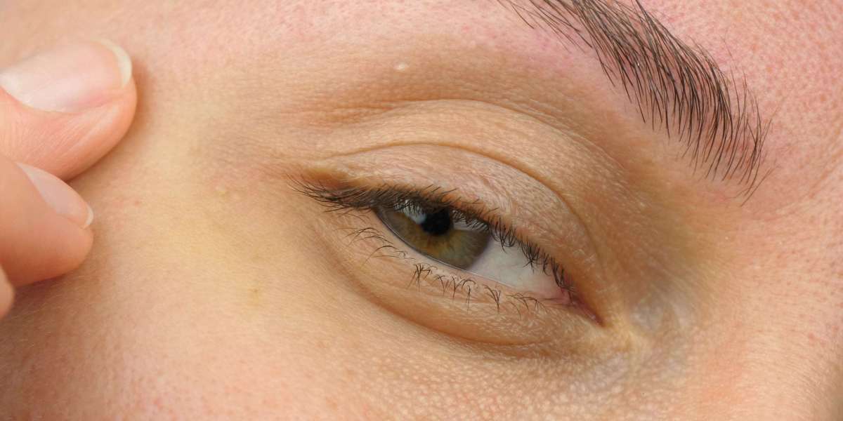 Are Chemical Peels Good for Milia Treatment?