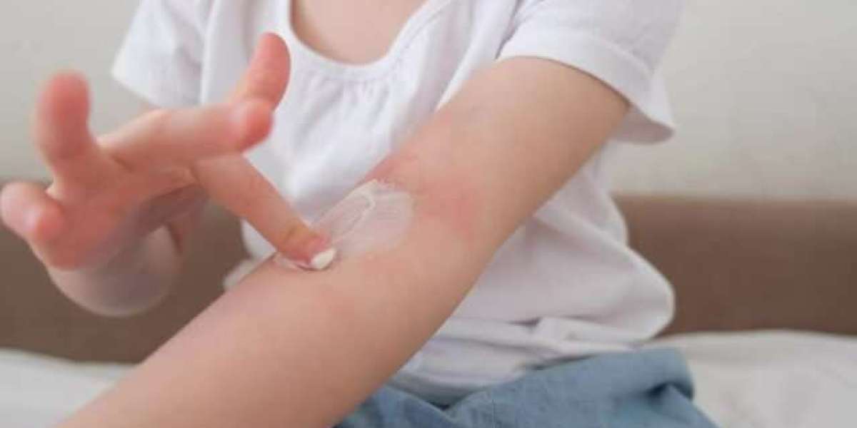 Atopic Dermatitis Market Insights Highlight Atopic Dermatitis Medication Shifts Driving Future Dermatology Innovation