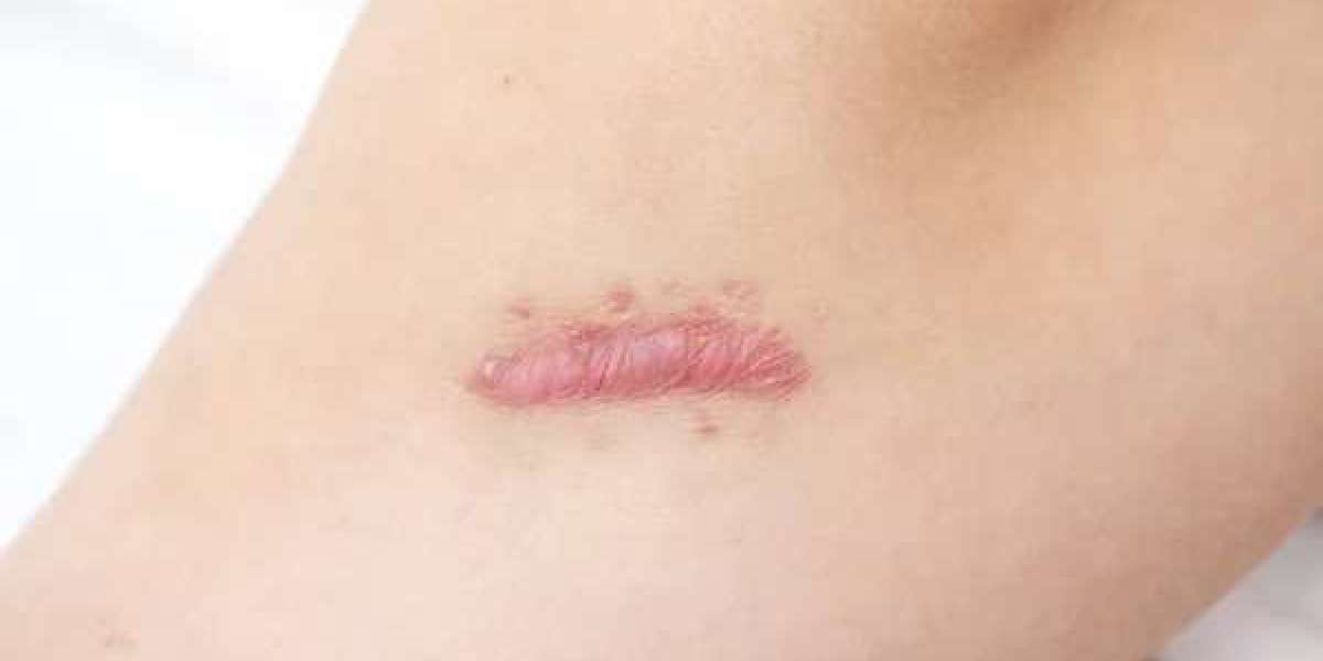 Do Hypertrophic Scars Only Appear on the Skin?