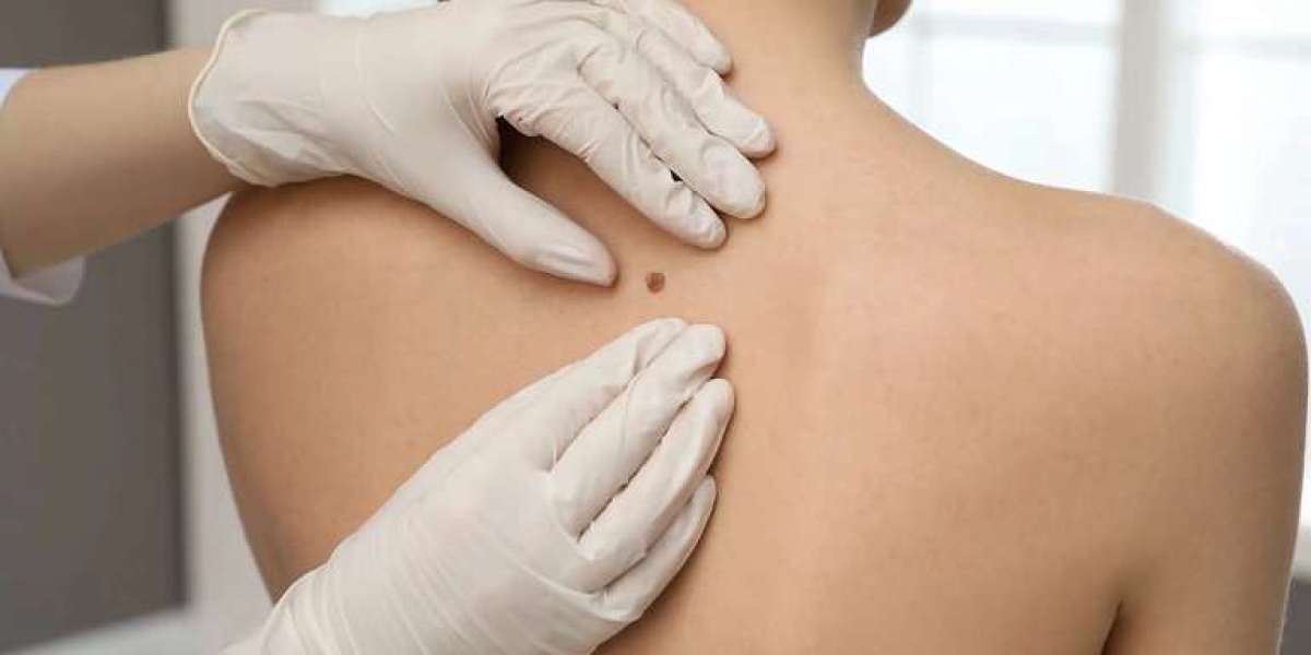 Is Mole Removal Cosmetic or Medical?