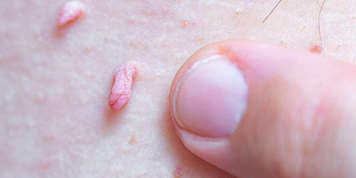 Do Skin Tags Increase With Age?