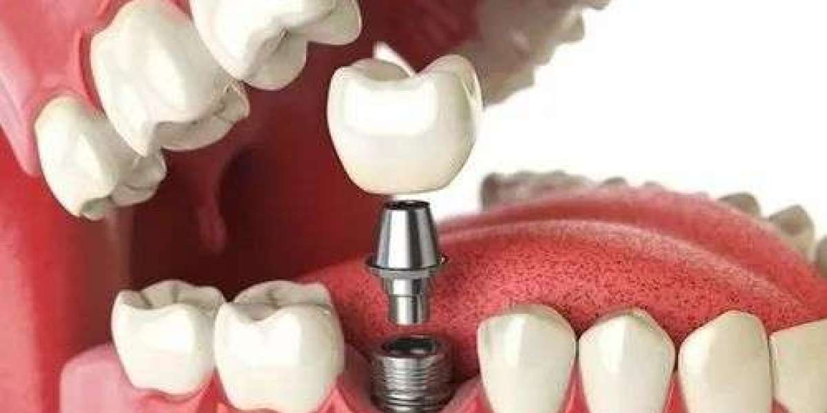 How Do You Maintain Results After Dental Implants?