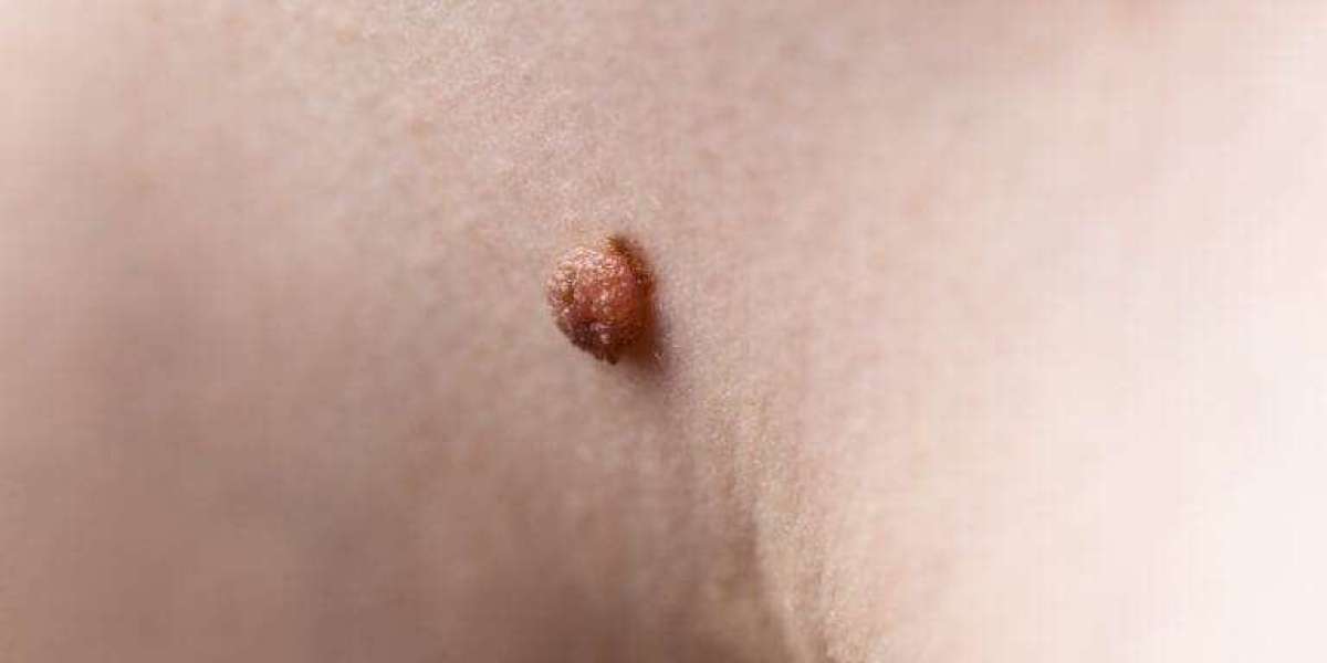 How Do Dermatologists Remove Skin Tags Quickly?