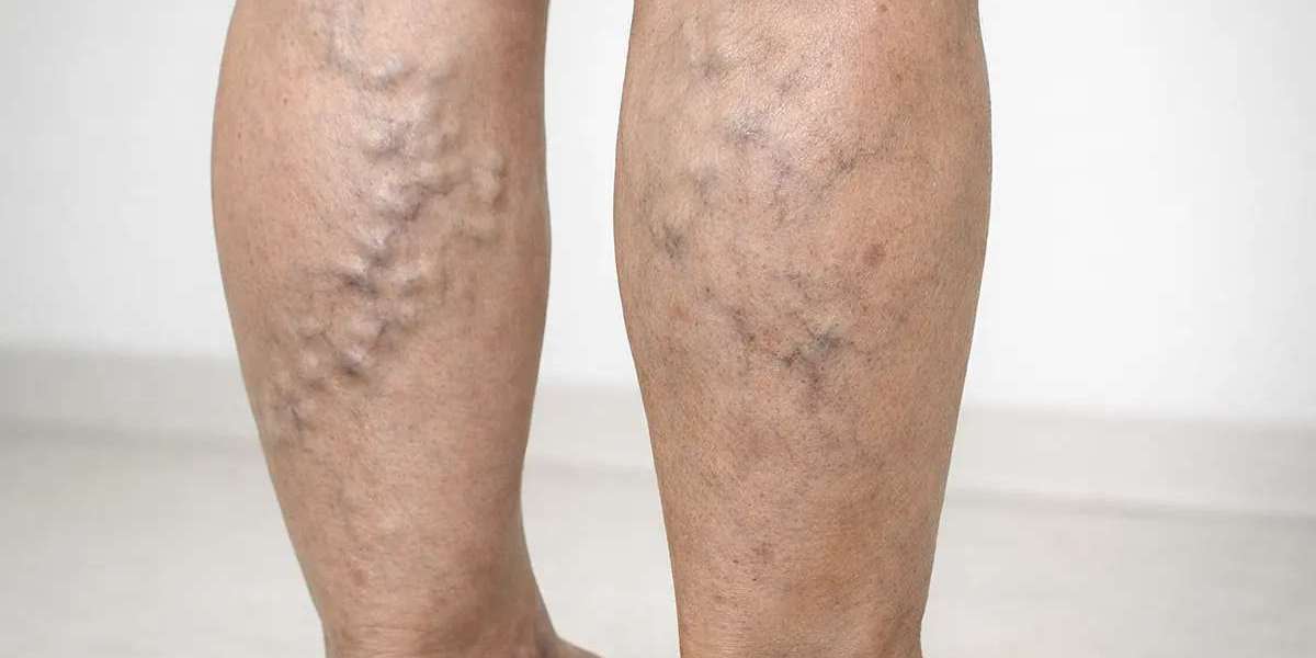 Is varicose veins treatment suitable for all ages?