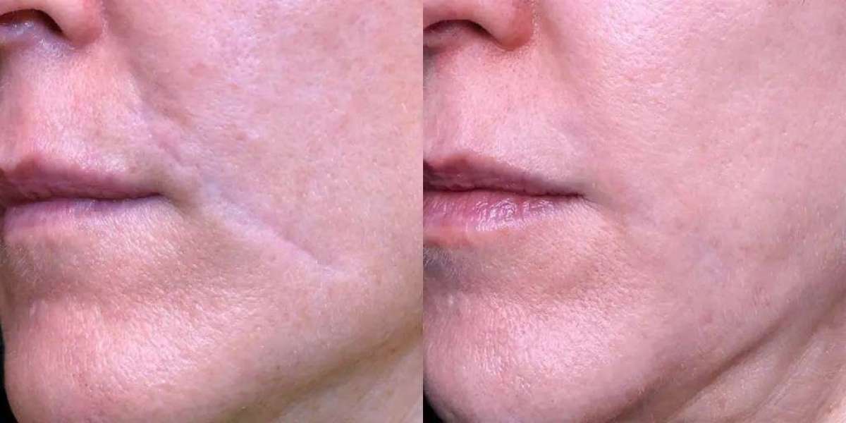 Surgical Scar Revision for Cosmetic Improvement: A Guide