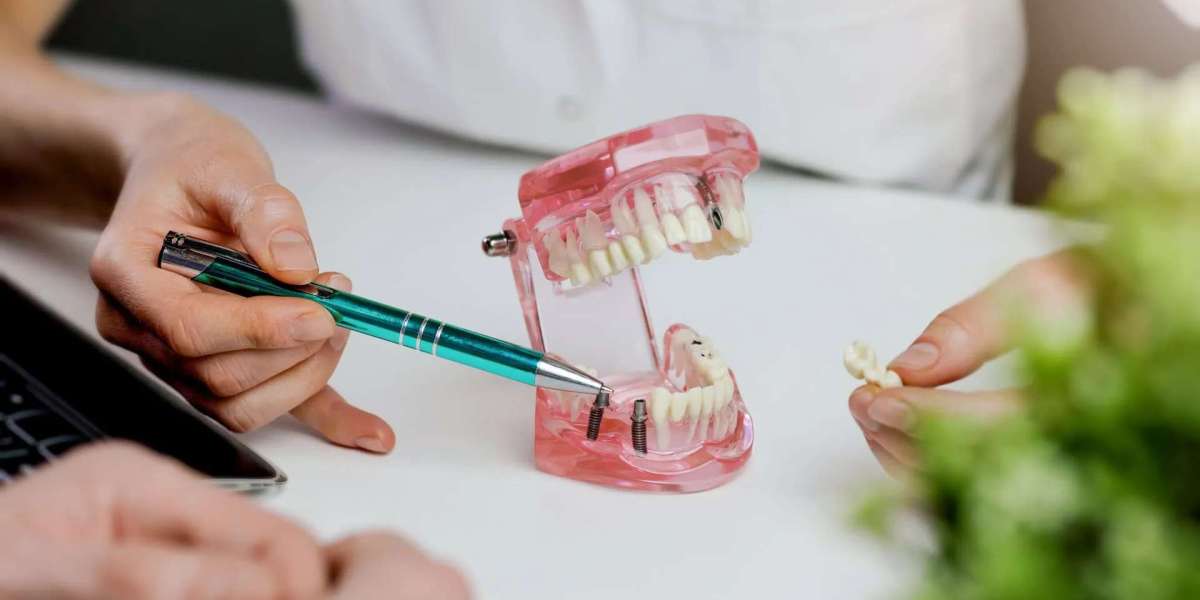 Are Dental Implants Safe? Latest Expert Insights
