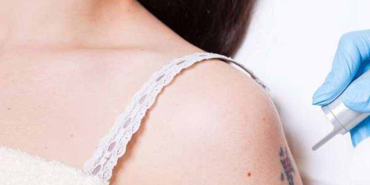 How Soon Can a Tattoo Be Removed?