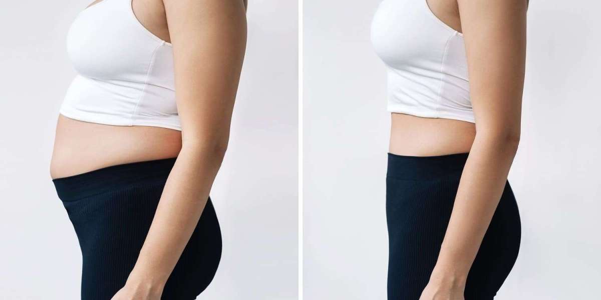 Transform Your Physique with Vaser 4D Liposuction at Glam Aesthetic Clinic