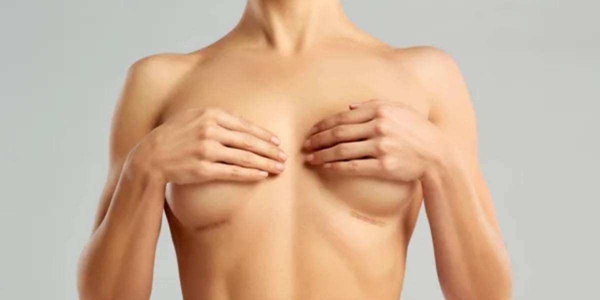Why Choose Breast Augmentation for Enhanced Curves?