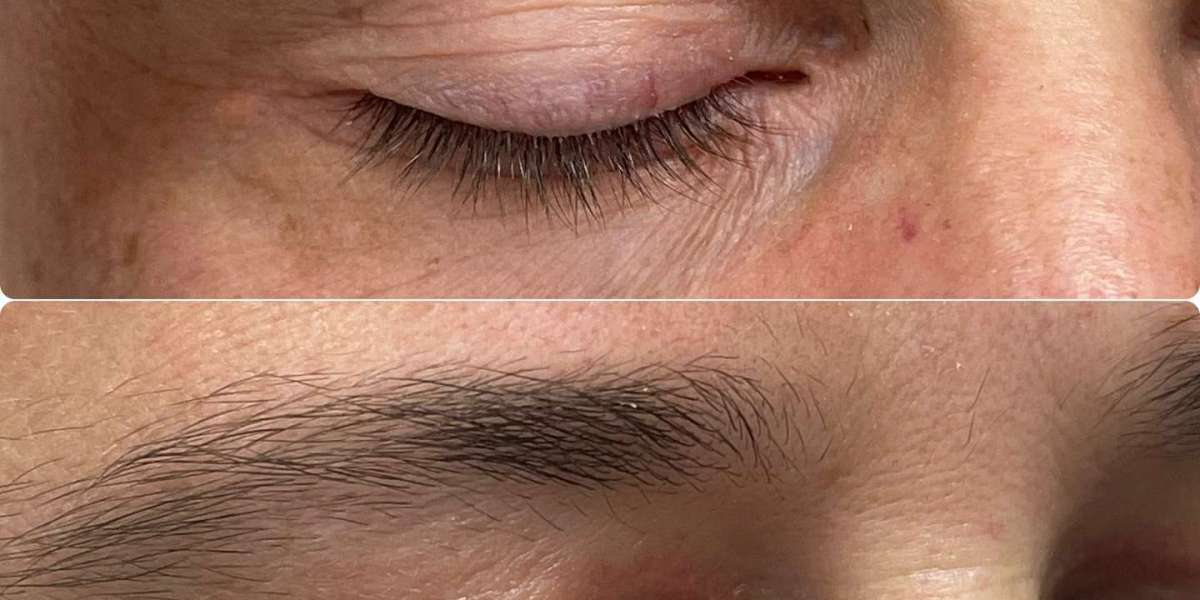 Eyelid Xanthelasma Removal and Cholesterol-Related Skin Changes